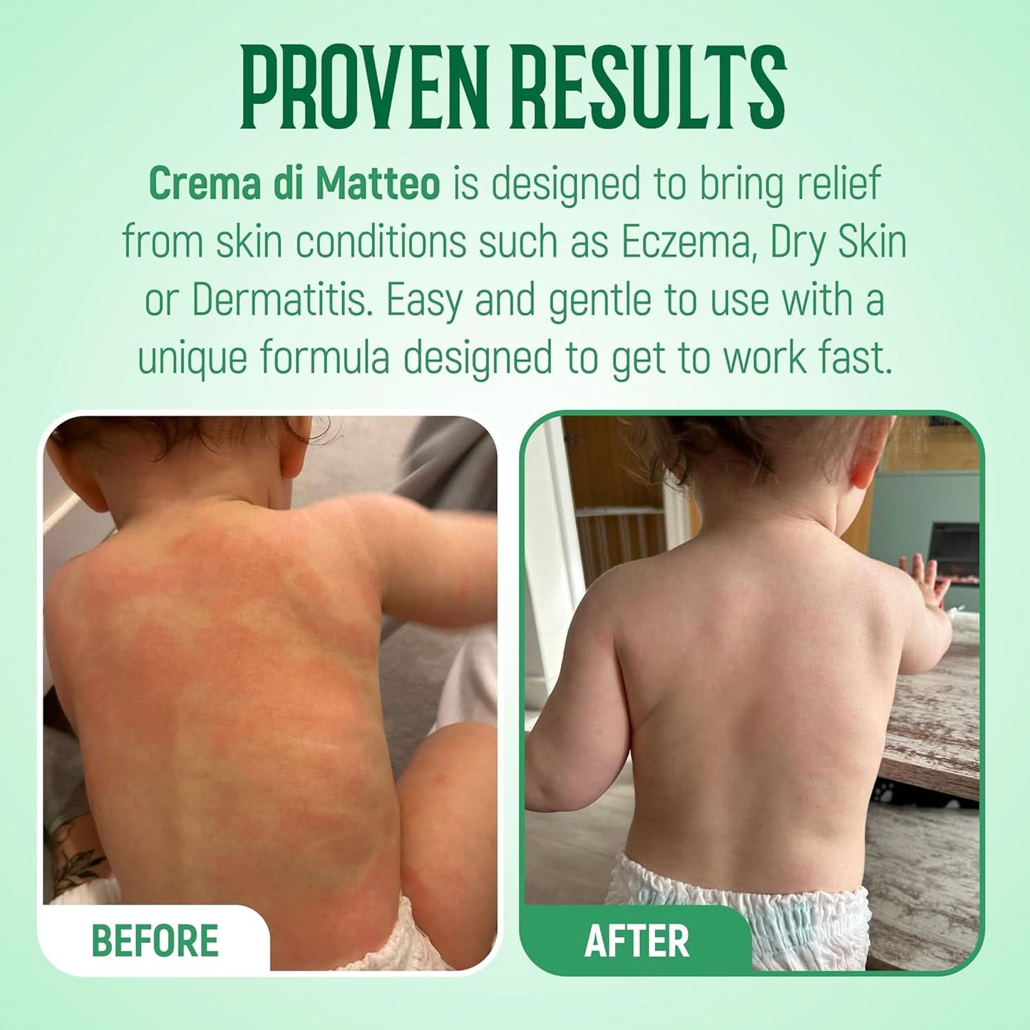Comparison image illustrating a child's back before and after using Crema Di Matteo Cream by 1936 Original for skin conditions. The "before" photo displays red, irritated skin, while the "after" showcases smooth, clear results with relieved itchiness. Text emphasizes the product's gentle and effective formula specifically designed as an eczema cream.